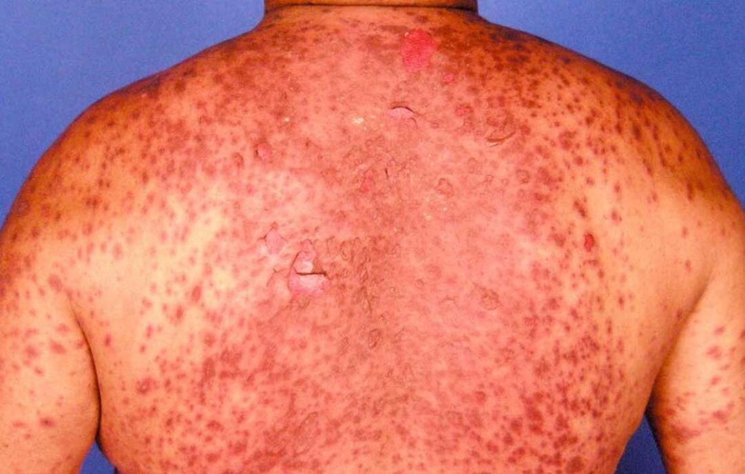 psorijatična eritrodermija na leđima