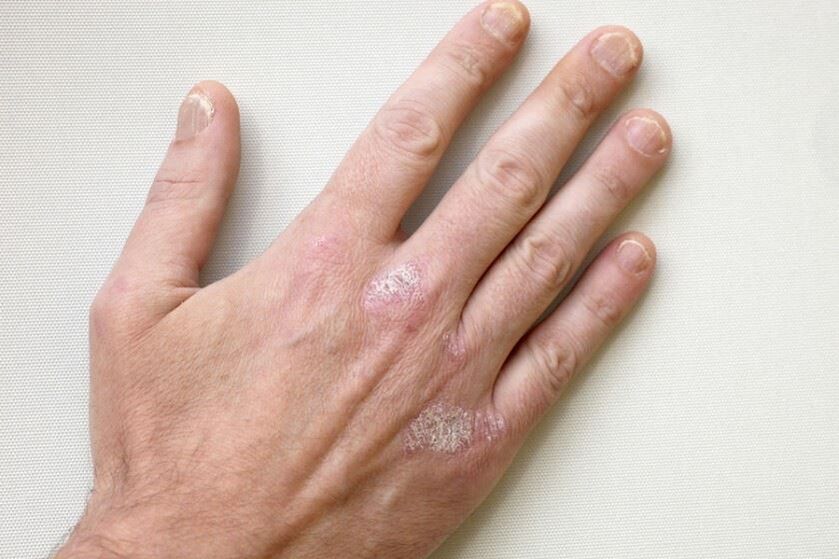 Obvezni simptom psorijaze su plakovi s ljuskama na koži