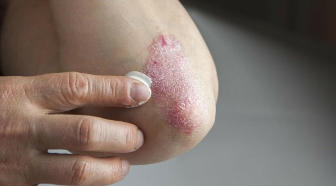 Psorijaza koja utječe na kožu, čije liječenje uključuje upotrebu masti