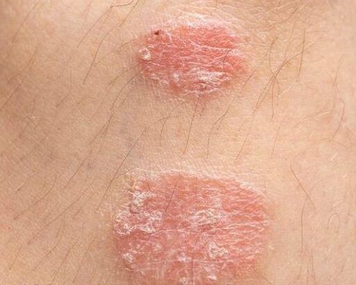 Pojava psorijatičnih plakova