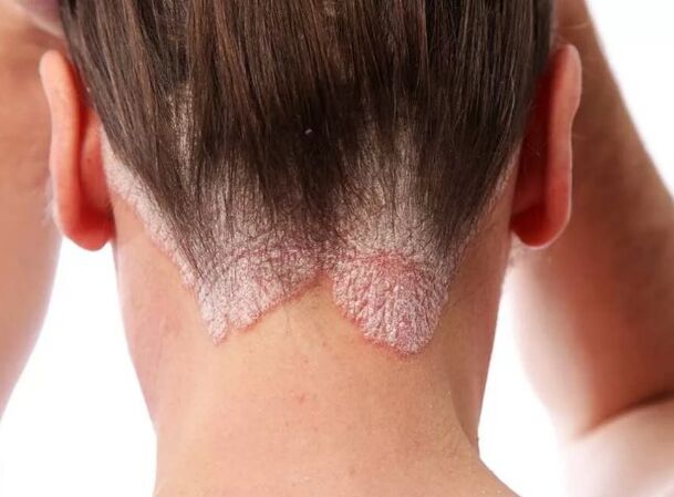 Psorijatična eritroderma
