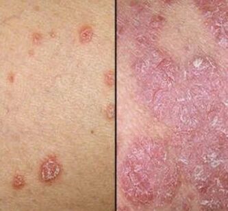 Psorijatični plakovi