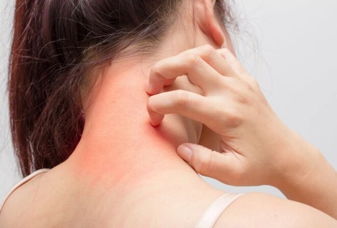 Svrab je jedan od uzroka psorijaze