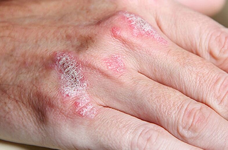 Psorijaza s ladomarijom