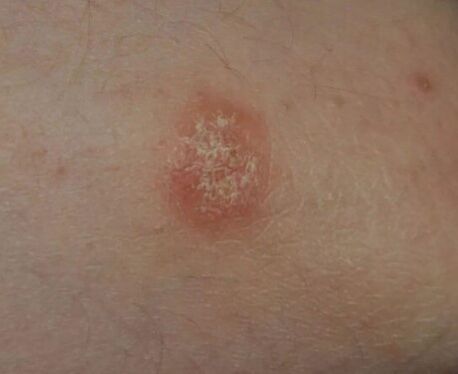 Psorijaza