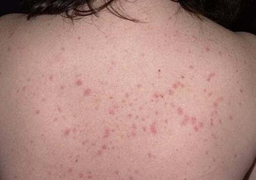 Početna faza psorijaze
