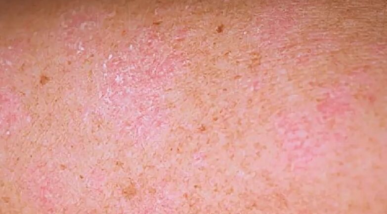 Regresivna faza psorijaze