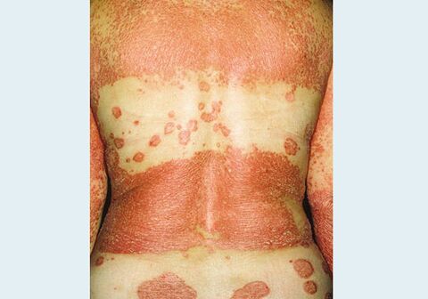 Genitalna psorijaza