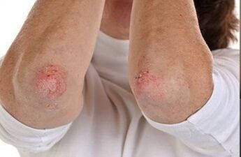 Psorijaza na laktovima