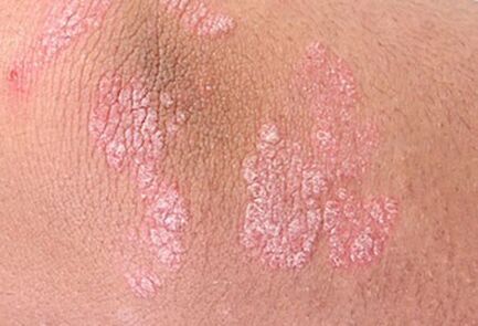 psorijaza