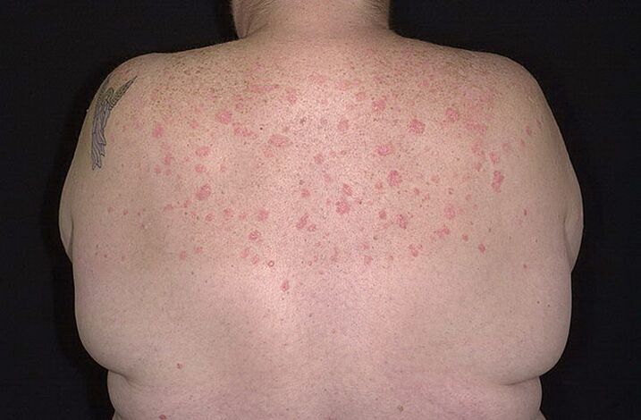 Psorijaza na ramenima