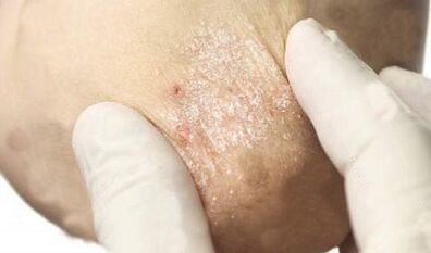 liječenje psorijaze u fazi slabljenja