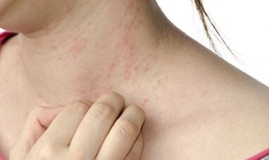 liječenje psorijaze u uznapredovalom stadiju
