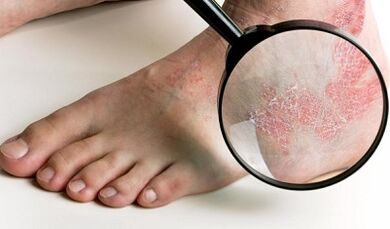 mogućnosti liječenja psorijaze
