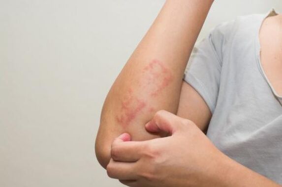Najnovije metode liječenja psorijaze