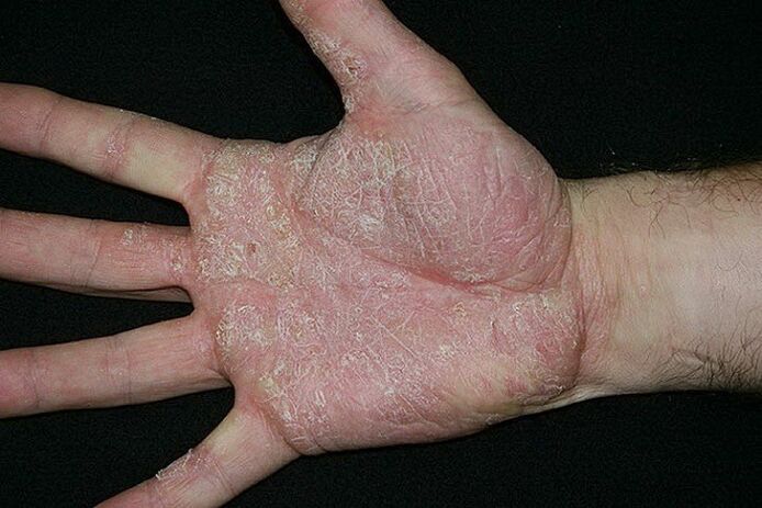 psorijaza dlanova i stopala