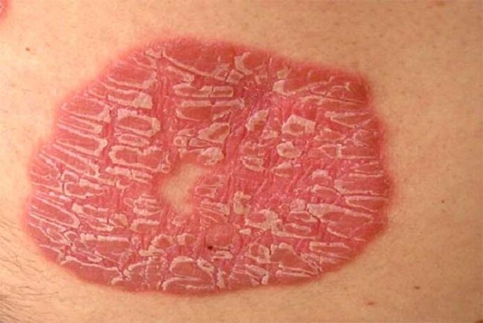 pustularna psorijaza