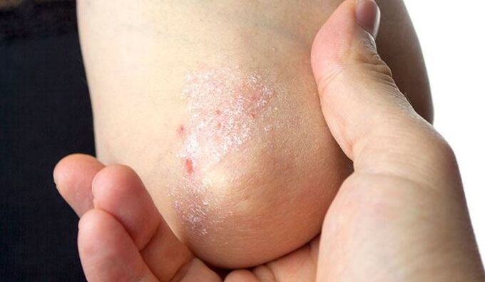 simptomi psorijaze u početnoj fazi