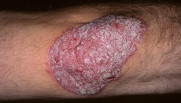 psorijaza